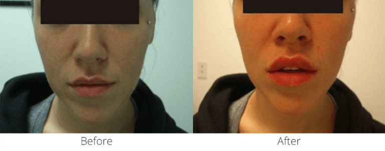 Before and After Treatments