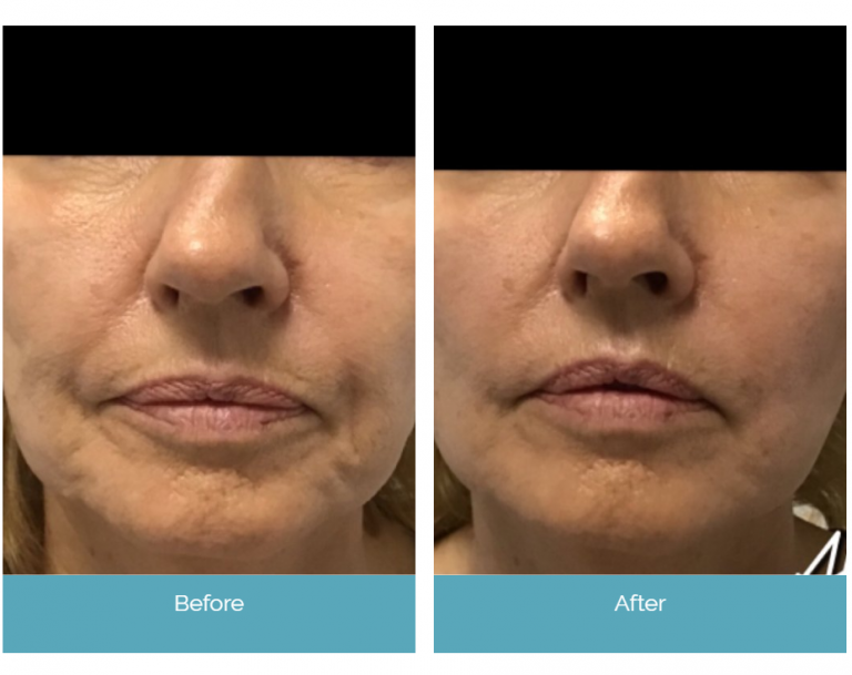 Before and After Treatments