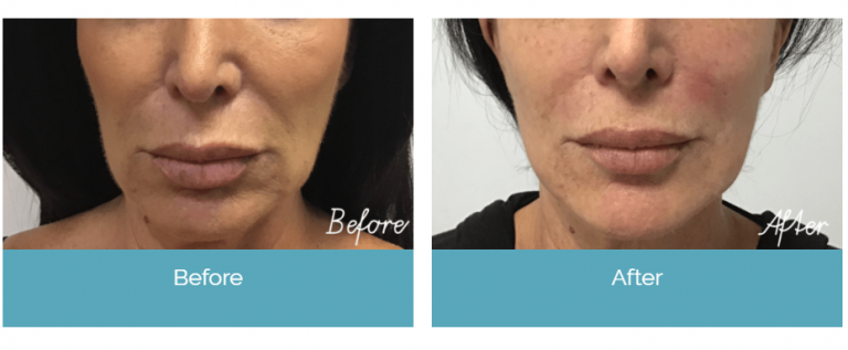 Before and After Treatments