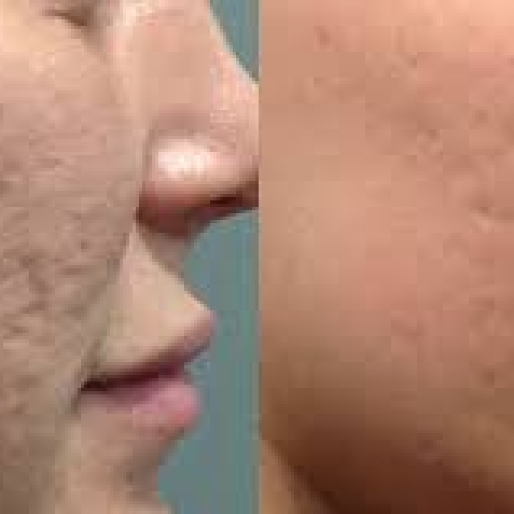 Microneedling