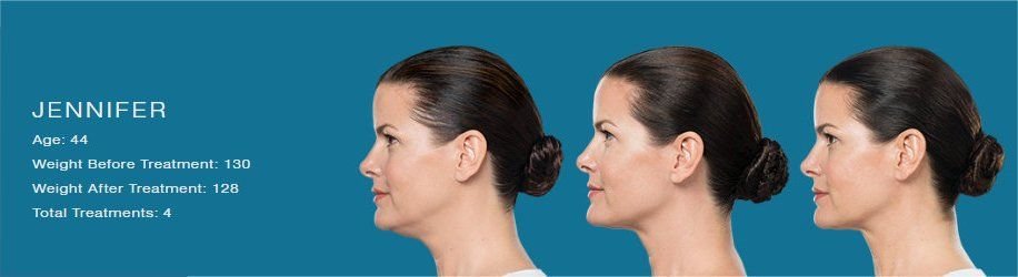 Kybella