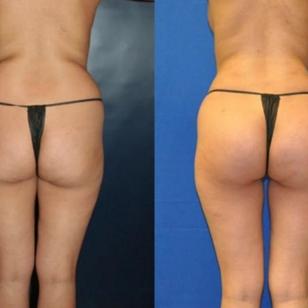 brazilian butt lift and love handle