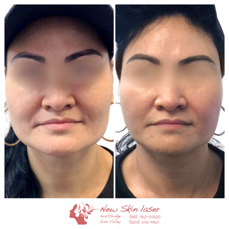 Botox Jaw Slimming & TMJ Treatment