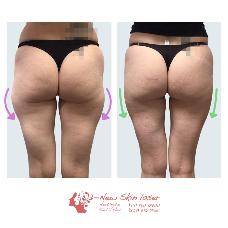 Liposuction Saddle Bags