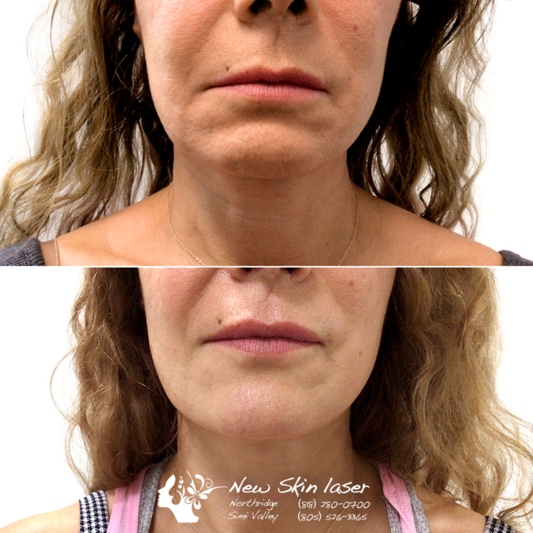 Chin Sculptra 1 Month Results