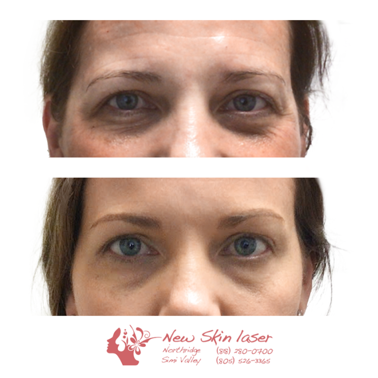 Botox for Crow's Feet & Forehead Lines