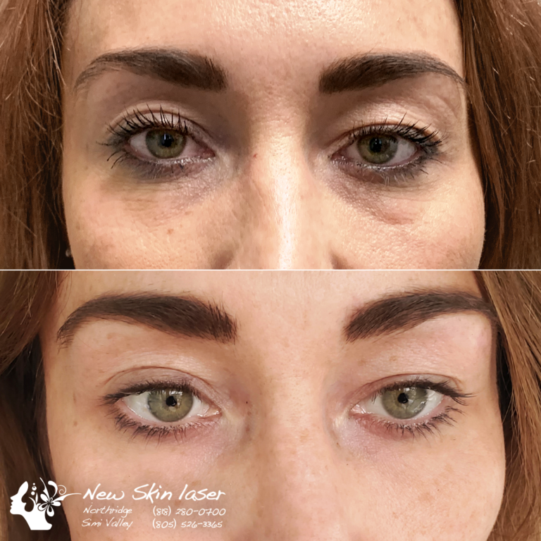 Botox for Under Eyes