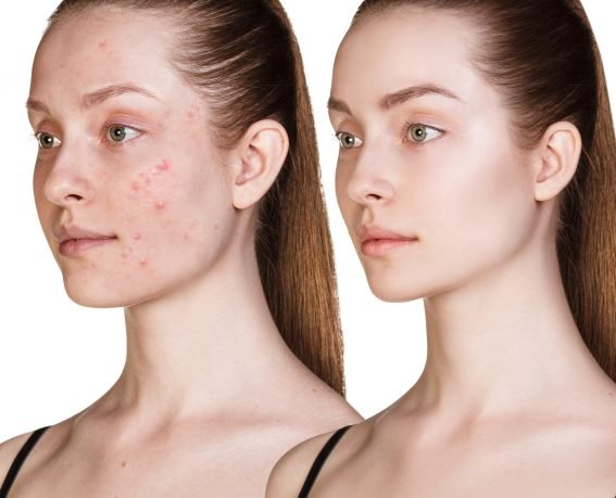 acne treatment